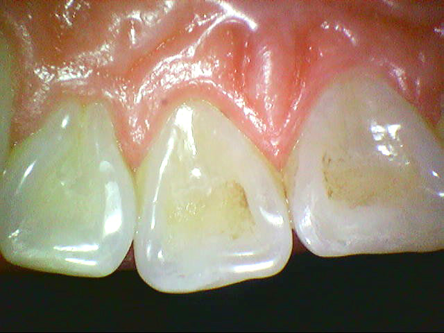 HDWill Camstar Intraoral Camera