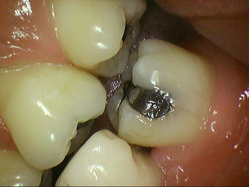 HDWill Camstar Intraoral Camera