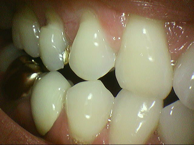 HDWill Camstar Intraoral Camera